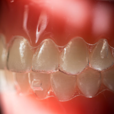 innovative-ortho-family-pictures-2966-400x400 Invisalign & Invisalign Teen  