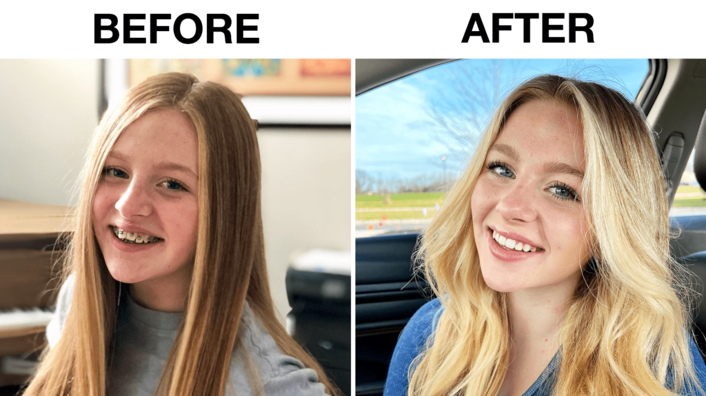 CQEXzUCg-1024x575 Before and After Braces: Lily's Story